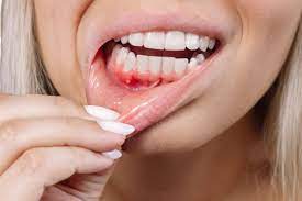 5 Stages of Receding Gum to Consider