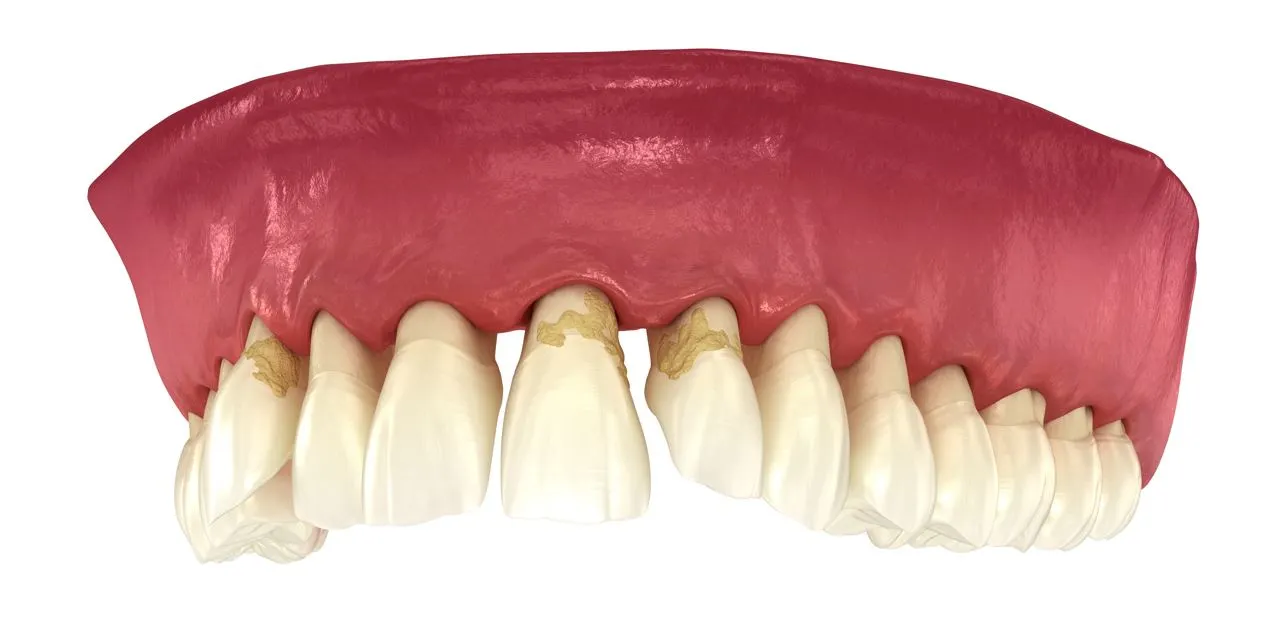 Gum Recession: Is it Too Late For Treatment?
