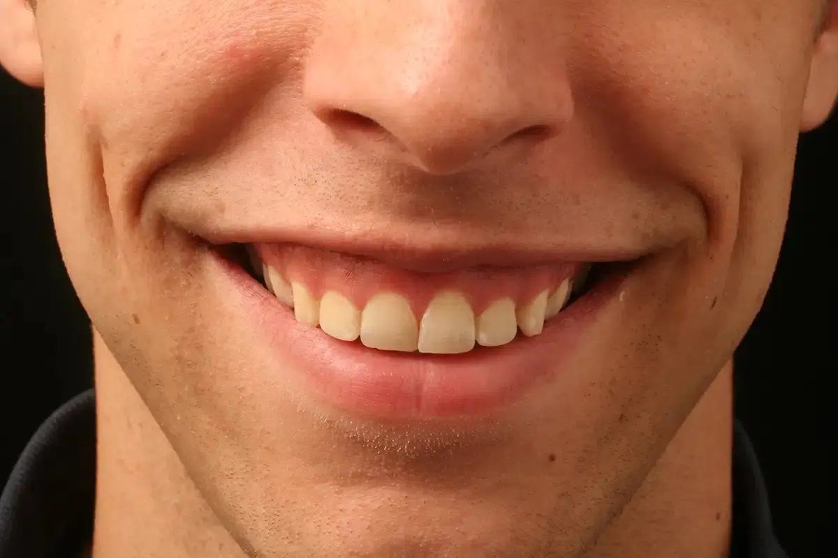Gummy Smile: Causes, Treatment Methods, and Frequently Asked Questions