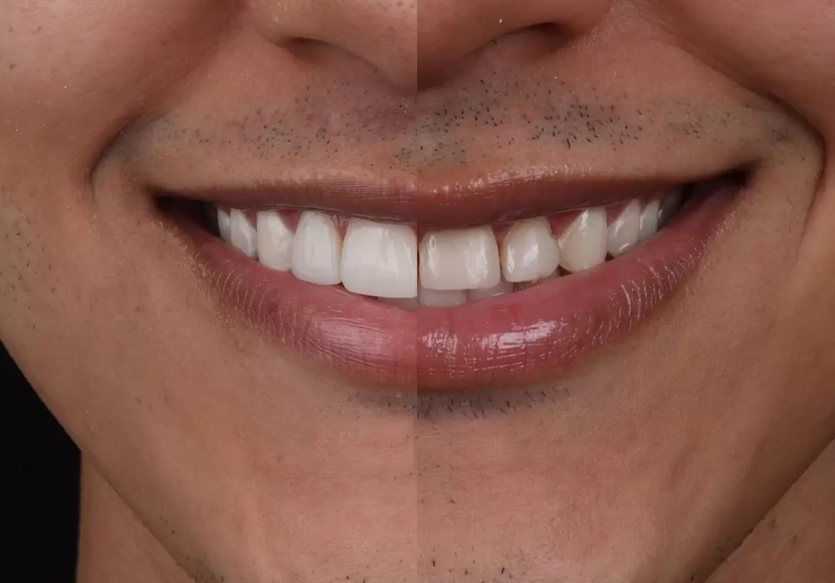 What Is Crown Lengthening Surgery? How Is It Performed?