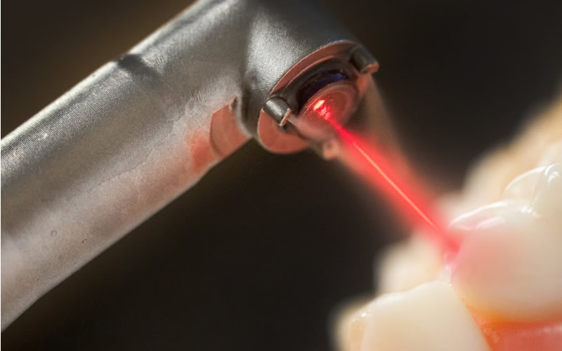 How Is Laser Root Canal Treatment Performed? 2026 Prices