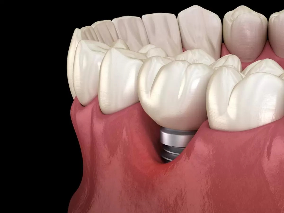 What Is Peri-implantitis Treatment? Why Is It Performed?