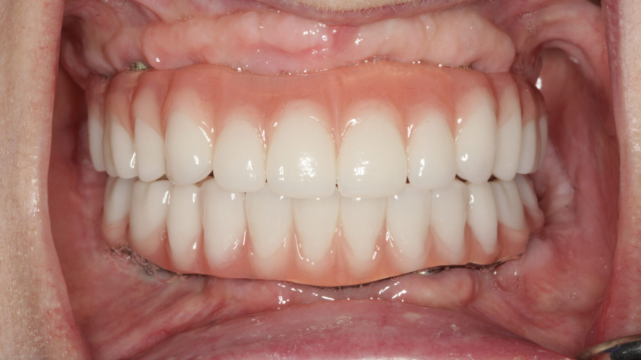What Is a Fixed Dental Prosthesis? How Is It Fitted and Cleaned?