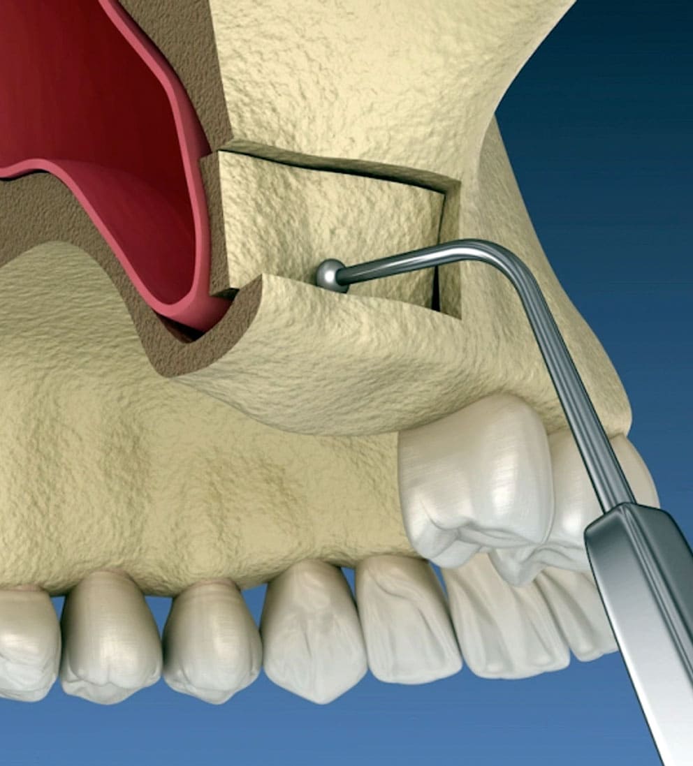 What Is Sinus Lift Surgery? Recovery and Aftercare