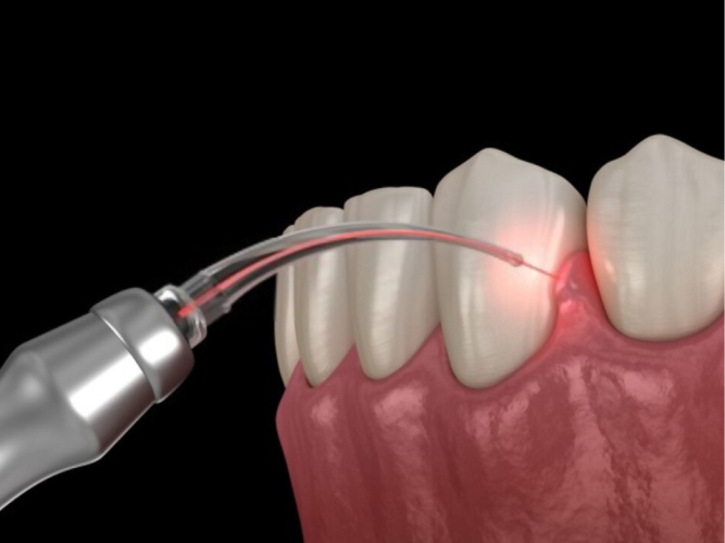 What to Watch Out for After Tooth Shaping