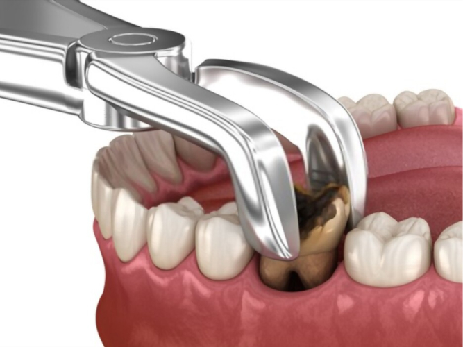 Kanal Treatment or Tooth Extraction?