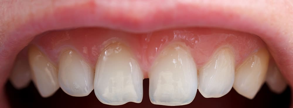 How to Detect Tooth Transparency and 3 Different Treatment Methods