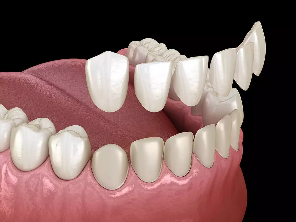 6 Important Facts About Laminate Veneers