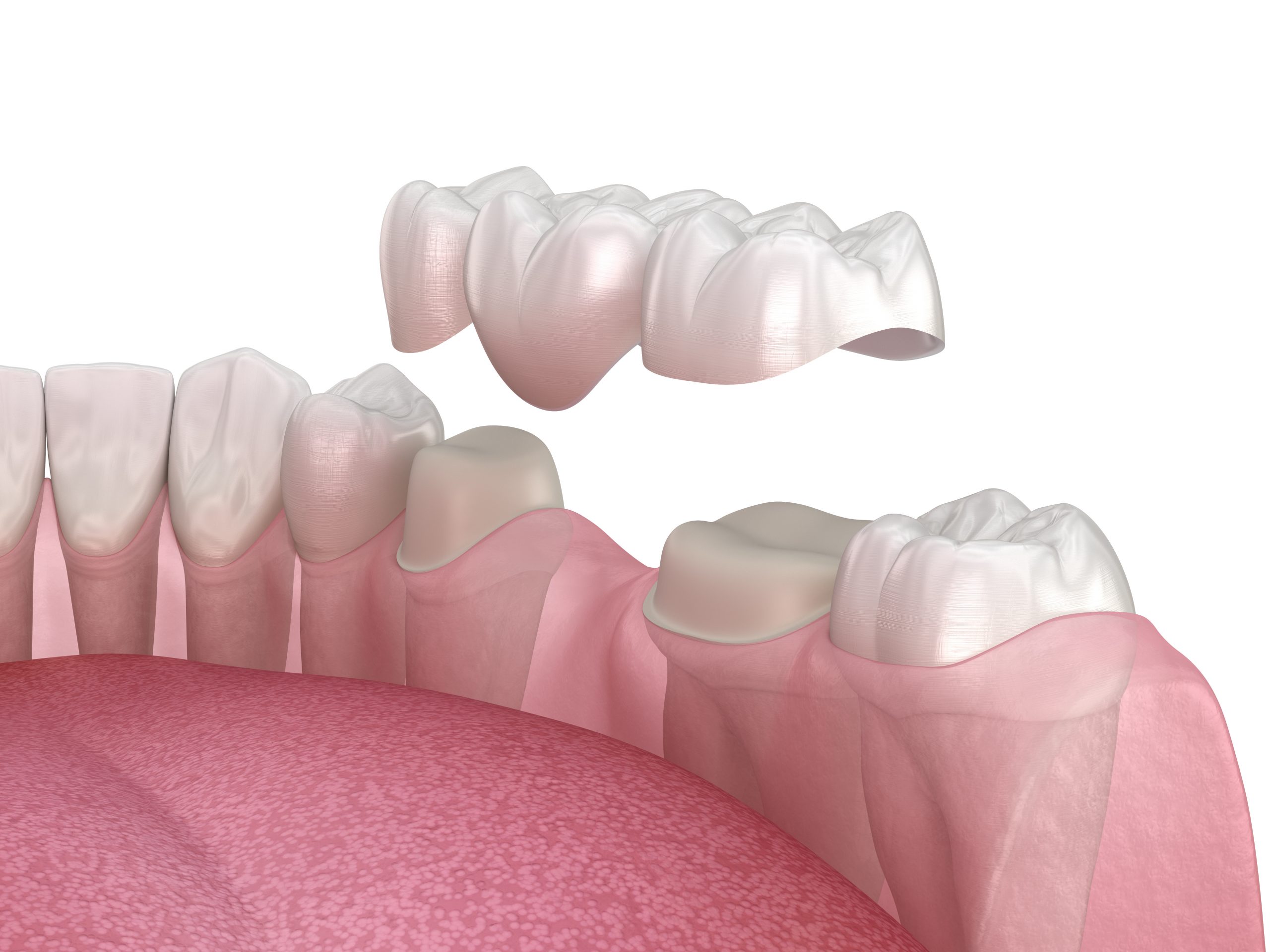 Implant Supported Bridges: What You Need to Know