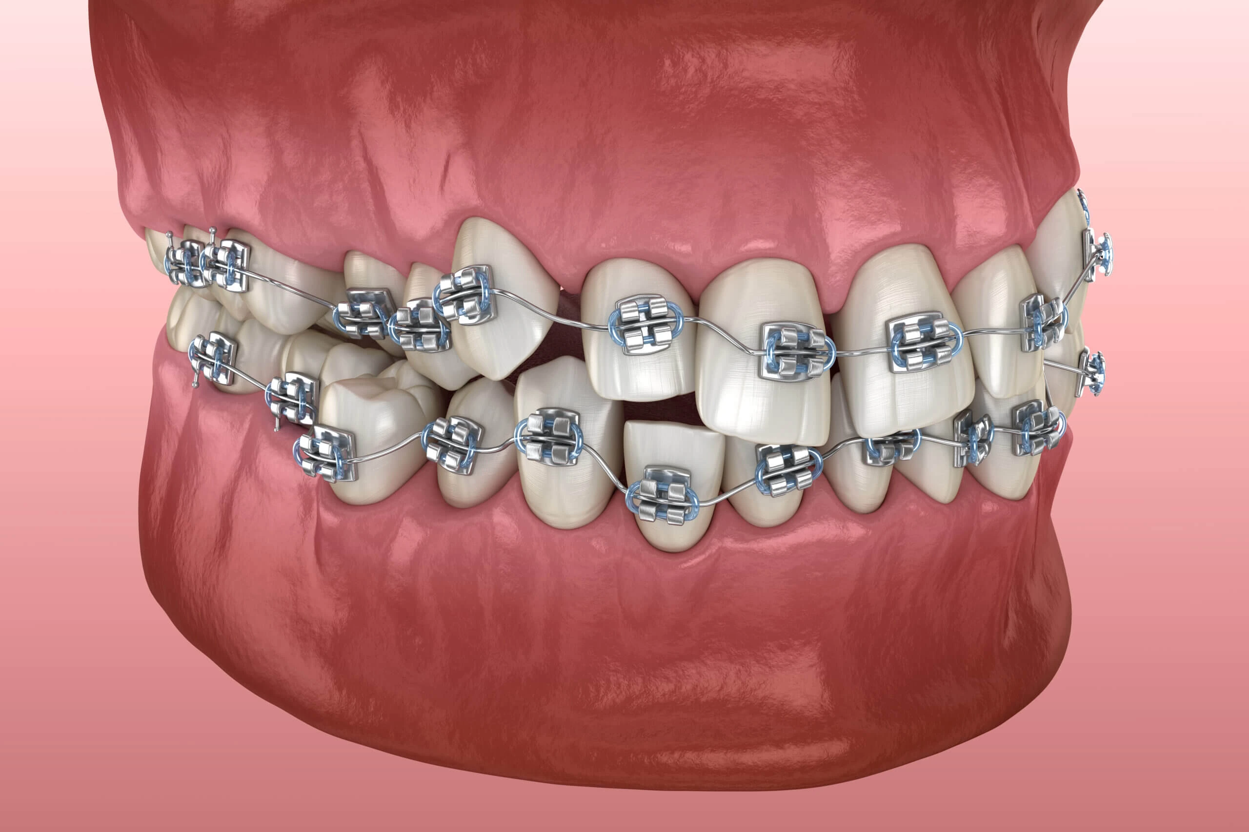 Ortodonti Nedir? Türleri, Faydaları ve Tedavi Seçenekleri