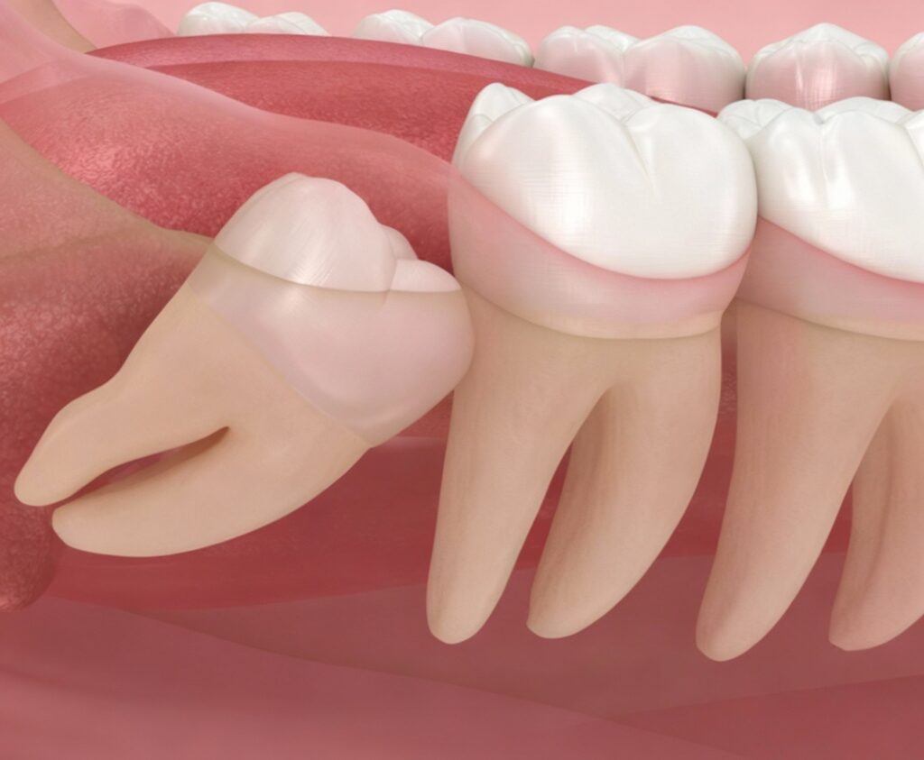 20'lik dişlerinin çekimi