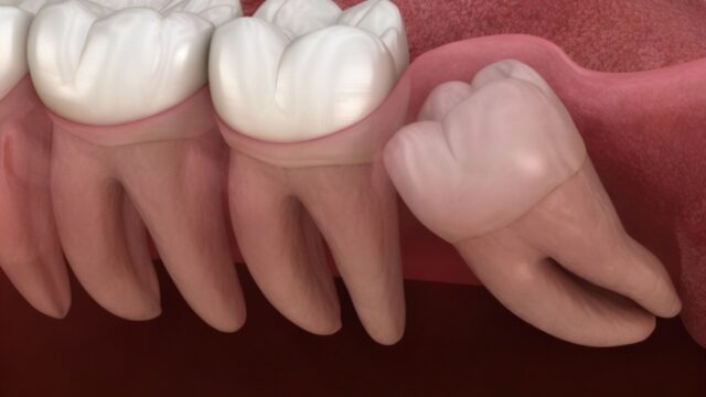 Wisdom Tooth Extraction: Recovery Process and Helpful Tips | Livera Dental Clinic