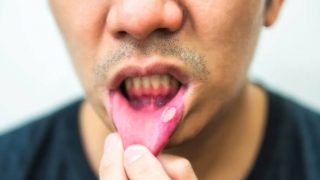 Ağızdaki Aft Nasıl Geçer? 4 mouth ulcers