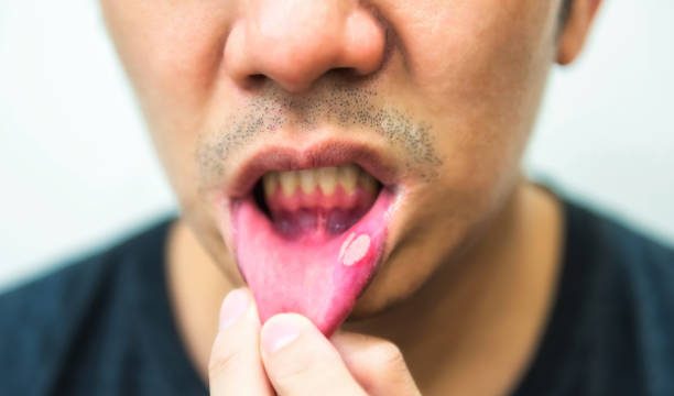 Ağızdaki Aft Nasıl Geçer? 7 mouth ulcers