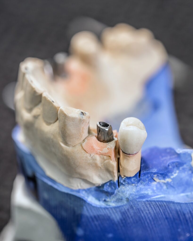 зубных имплантатов