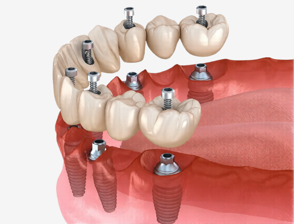зубных имплантатов