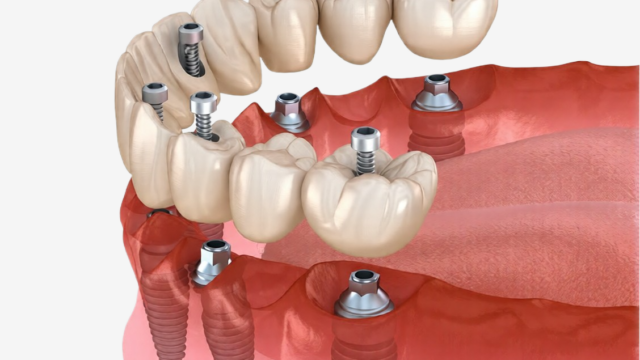 all-on-6-dis-implanti-on-degerlendirme | Livera Dental Clinic