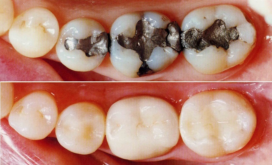 amalgam fillings