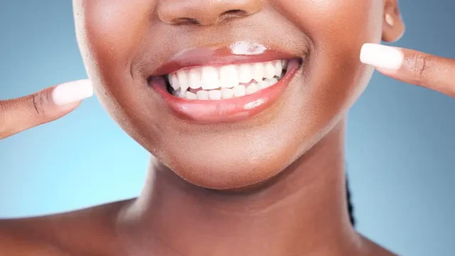 Invisalign