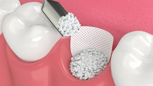 Everything You Need to Know About Dental Bone Grafting | Livera Dental Clinic