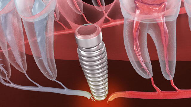 Dental Implant