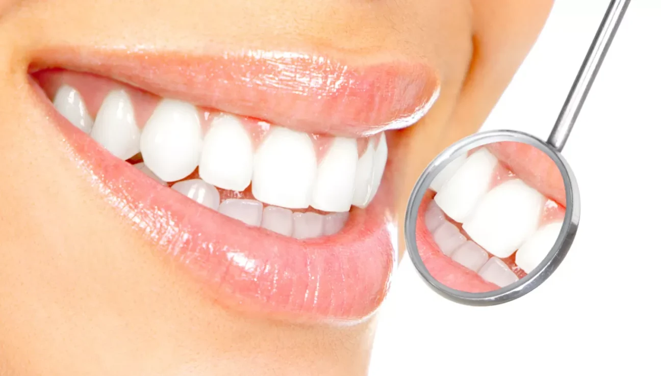 Can Veneers Be Whitened? | Livera Dental Clinic