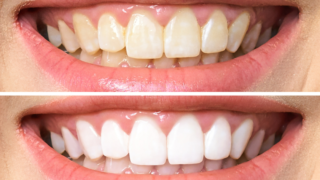 can-veneers-whitened | Livera Dental Clinic