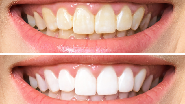 can-veneers-whitened | Livera Dental Clinic