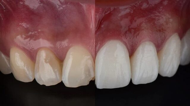 Straumann İmplantları