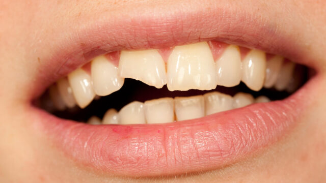 Cracked Teeth: What Are They, Why Do They Occur, and How Are They Treated? | Livera Dental Clinic Istanbul