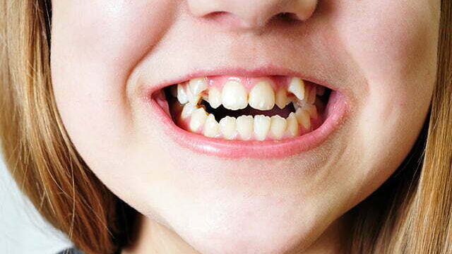 Malocclusion: Types, Causes, Expenses, and Costs | Livera Dental Clinic Istanbul