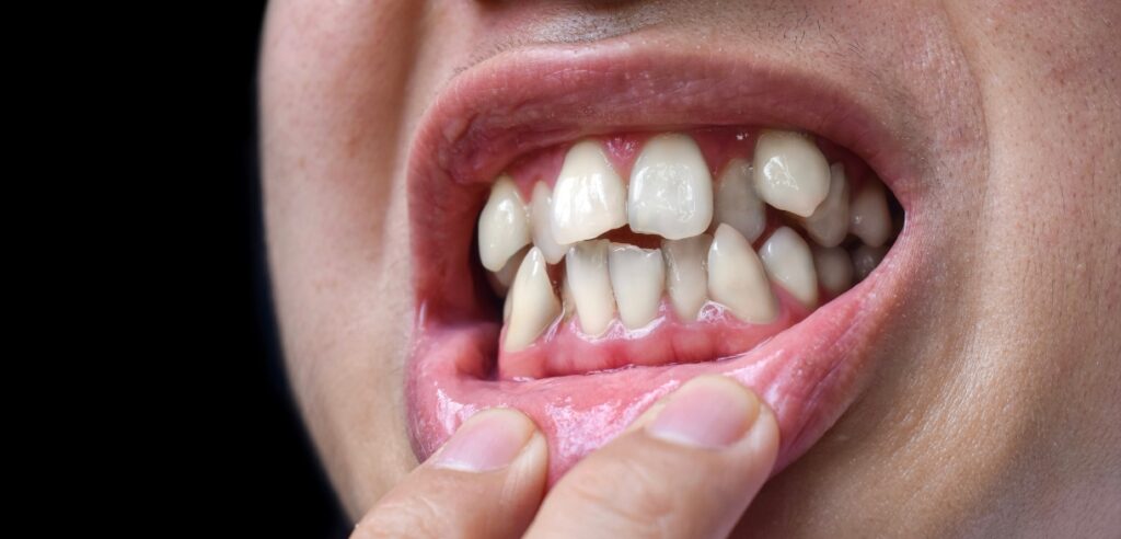 Crooked Teeth: Evolutionary Perspectives on Developmental Causes | Livera Dental Clinic