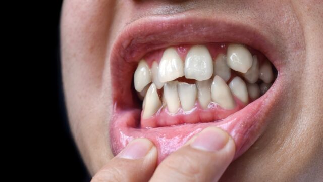 Crooked Teeth: Evolutionary Perspectives on Developmental Causes | Livera Dental Clinic