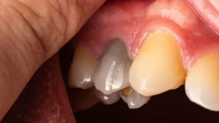 Dental Bridge
