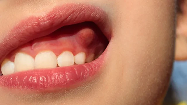 What is a dental abscess, and how does it go away? | Livera Dental Clinic