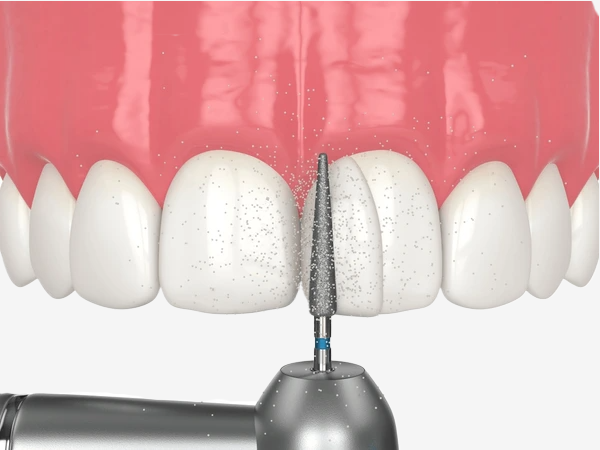 Bonding vs Veneer: Temel Farklar 2 Bonding vs Veneer