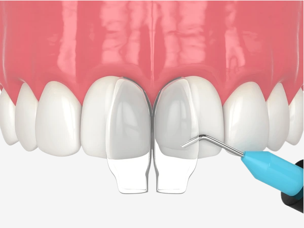 Bonding vs Veneer: Temel Farklar 1 Bonding vs Veneer