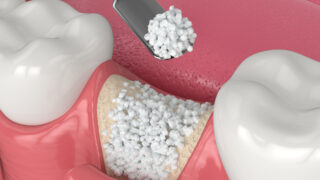 Gum Graft Surgery Methods and Procedures 4 teeth