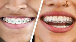 Emily Alyn Lind dişleri