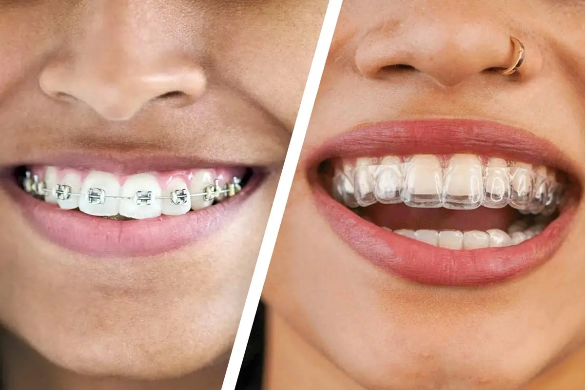Braces or Clear Aligners: Which Option Suits You Best? | Livera Dental Clinic