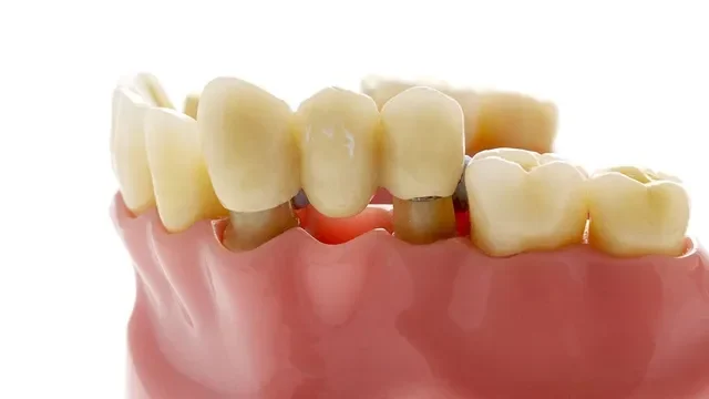 Diş Eti Hastalığı