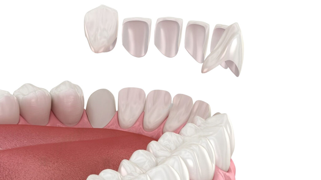 Laminalar vs. Kronlar