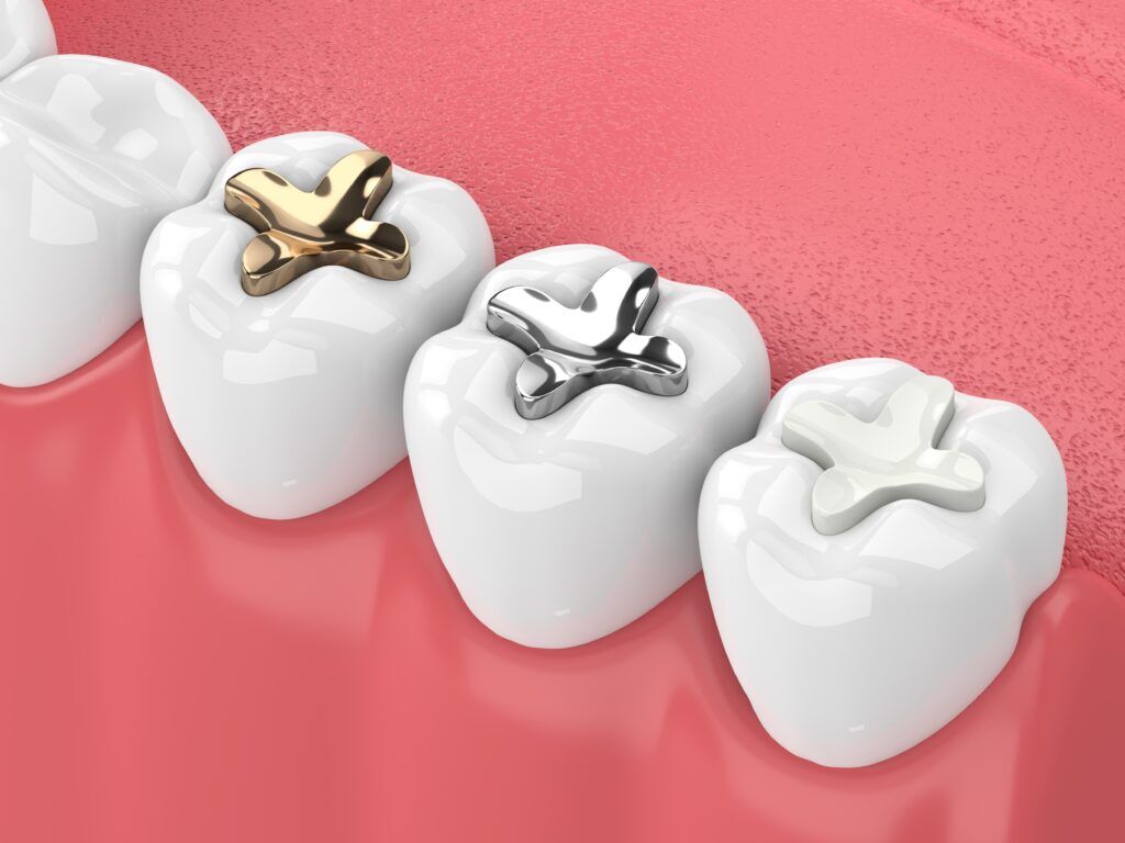 dental fillings