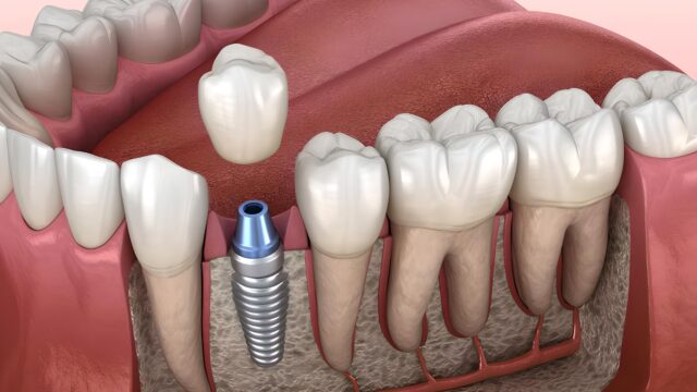 What is a Dental Implant Abutment? Its Role and Importance | Livera Dental Clinic