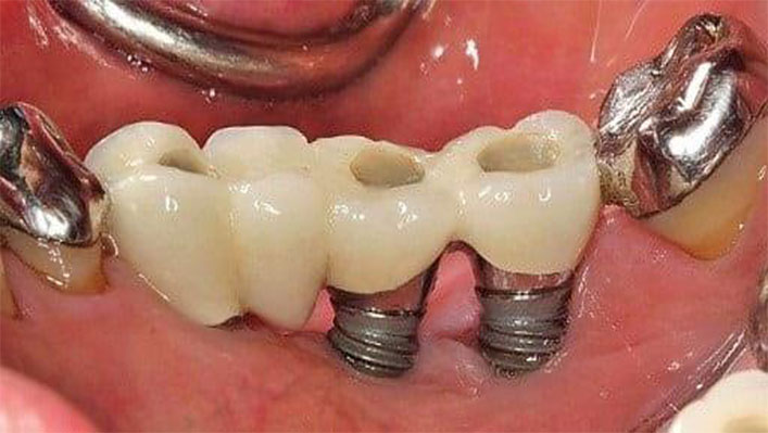 Diş İmplantı Başarısızlığı