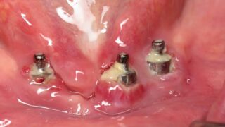 Diş İmplantı Başarısızlığı