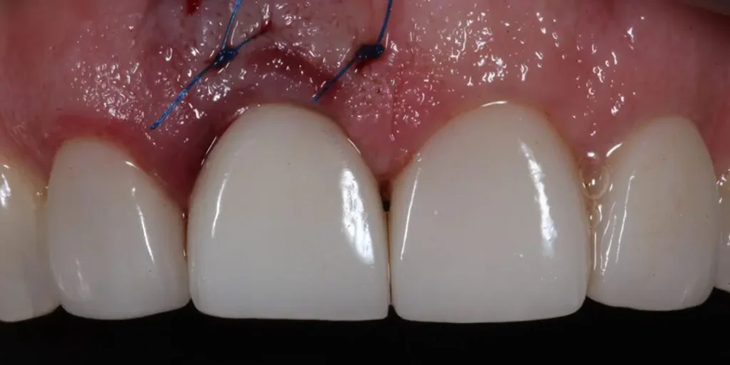 Dental Implants for Front Teeth