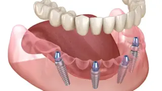 Dental Implant