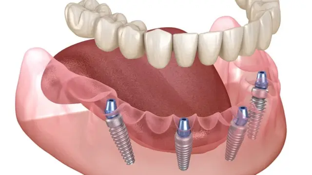 Dental Implant