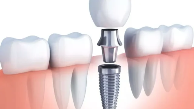 How many dental implants can be placed in one session? | Livera Dental Clinic